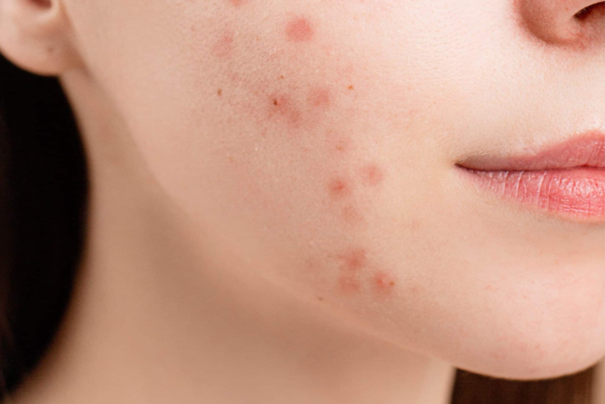 Todo lo que debes saber sobre el acné hormonal, ¡hablamos con los expertos!